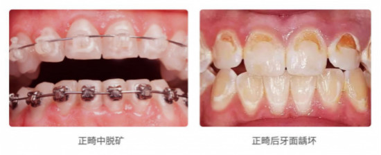 在做正畸吗?那你需要用iPMTC来管控口腔细菌环境