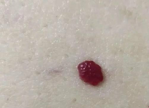 芙艾医疗施教授提醒您:身上出现红色“血痣”?可能是草莓样血管瘤