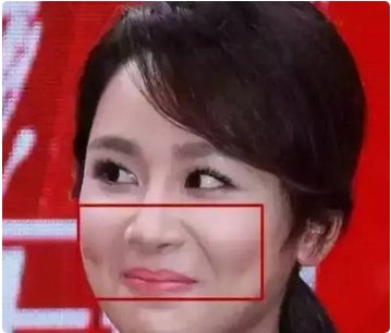 芙艾医疗教您一招去除该死的「法令纹」!