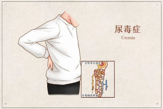 青岛静康肾病医院怎么样啊?尿毒症透析后还能活多久?